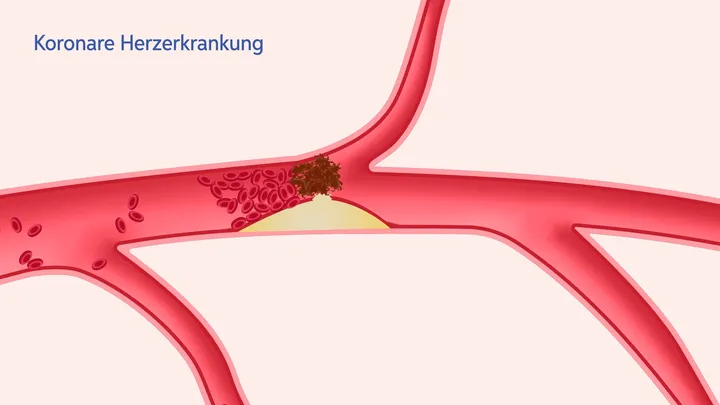 Diabetes Explainers — screenshot 2