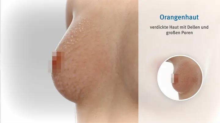 Breast Cancer Symptoms — screenshot 4
