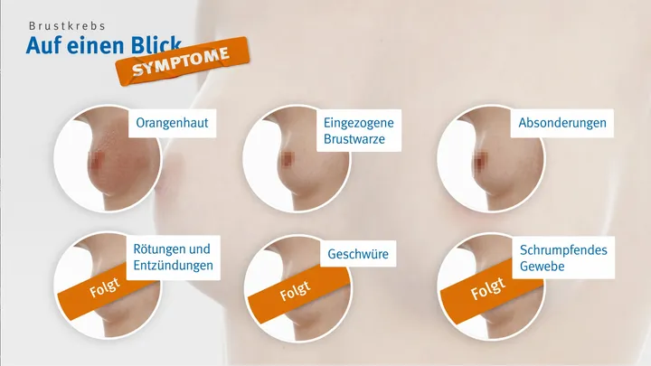 Breast Cancer Symptoms — screenshot 1