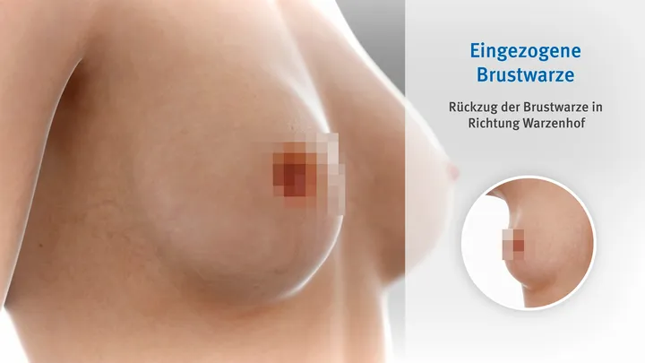 Breast Cancer Symptoms — screenshot 5